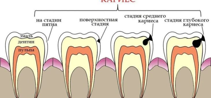 НЕПРОЛЕЧЕННЫЙ КАРИЕС ОЧЕНЬ ОПАСЕН!